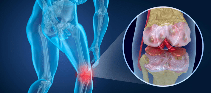 Arthritis and Long-Term Disability Claims: What You Need to Know