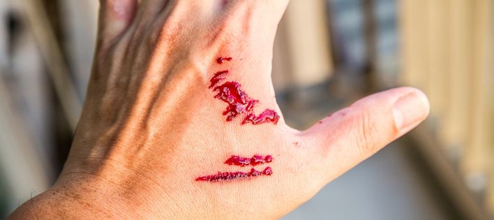 What Legal Actions Can You Take After a Dog Bite?