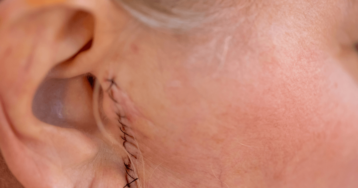 Scar Injury Settlement in Ontario What Victims Should Know